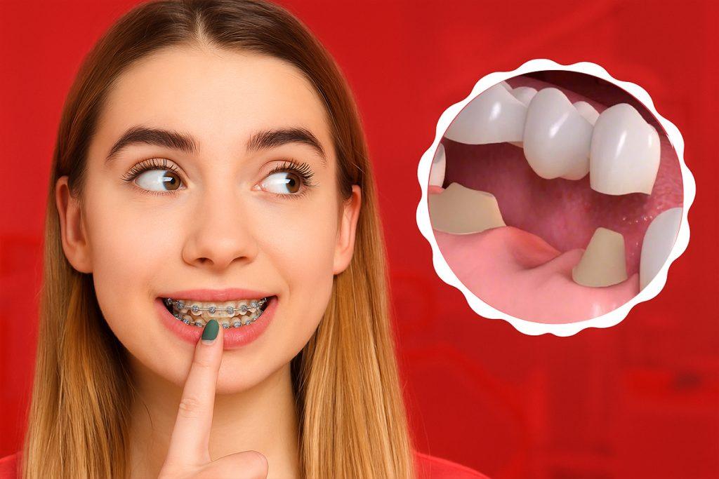 Làm Răng Sứ Có Niềng Răng Được Không ?