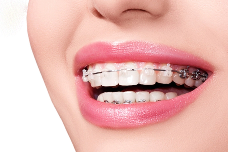 Làm Răng Sứ Có Niềng Răng Được Không ?