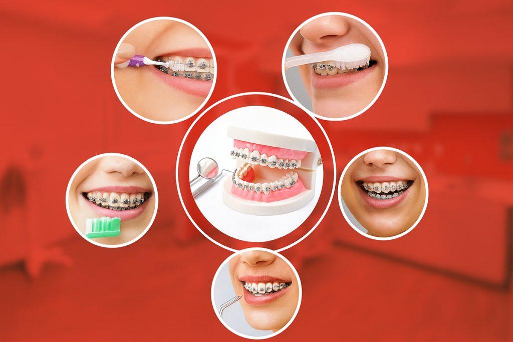 Hướng Dẫn Chăm Sóc Sau Niềng Răng