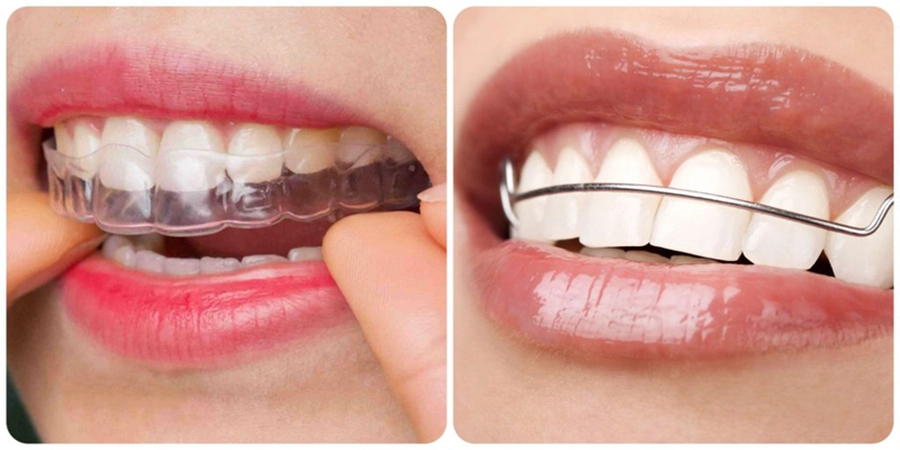 Hướng Dẫn Chăm Sóc Sau Niềng Răng