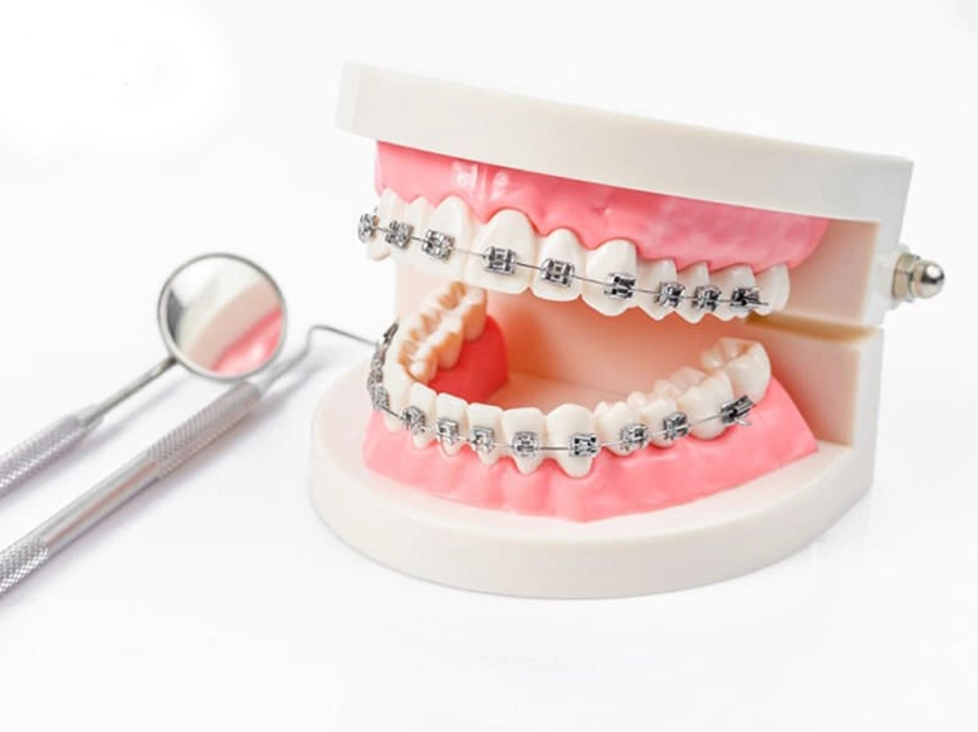 Hướng Dẫn Chăm Sóc Sau Niềng Răng