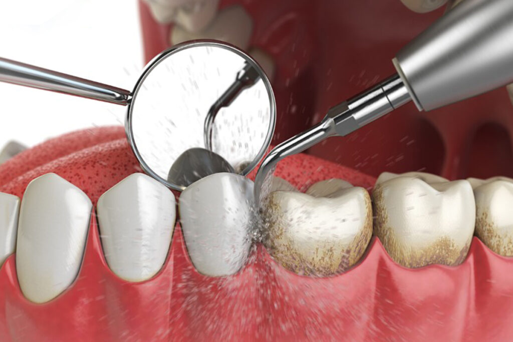 Cạo Vôi Răng Định Kỳ Có Quan Trọng Không?