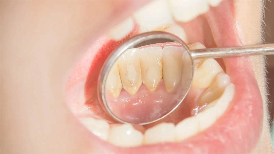 Cạo Vôi Răng Định Kỳ Có Quan Trọng Không?