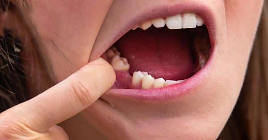 Mất Răng Lâu Năm Có Cấy Implant Được Không?