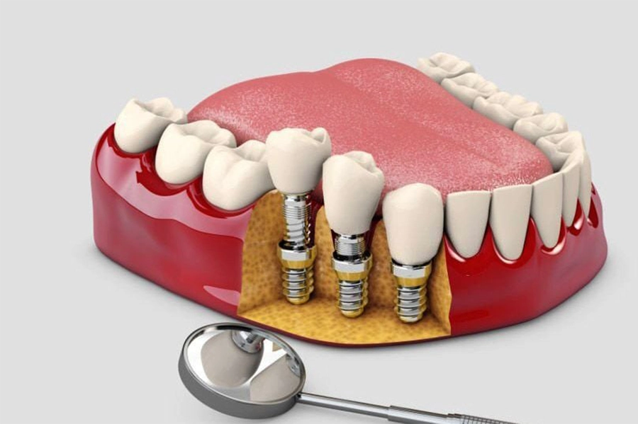 Mất Răng Lâu Năm Có Cấy Implant Được Không?