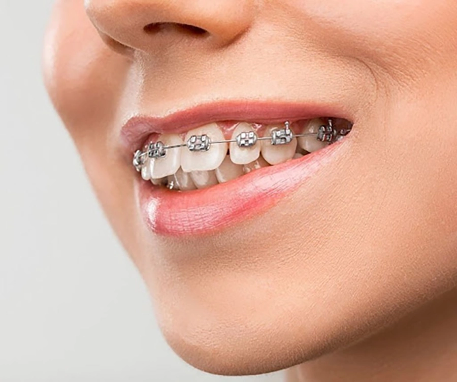 Niềng răng người lớn – Có muộn quá không?