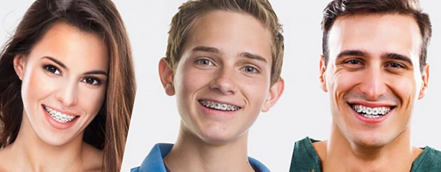 Niềng răng người lớn – Có muộn quá không?