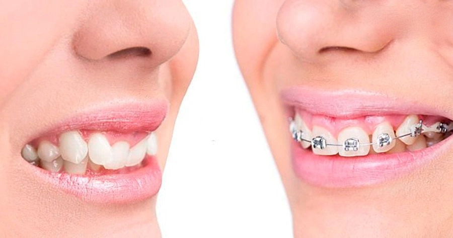 Niềng răng người lớn – Có muộn quá không?