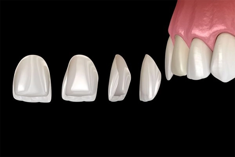 Phương Pháp Dán Sứ Veneer: Ưu & Nhược Điểm