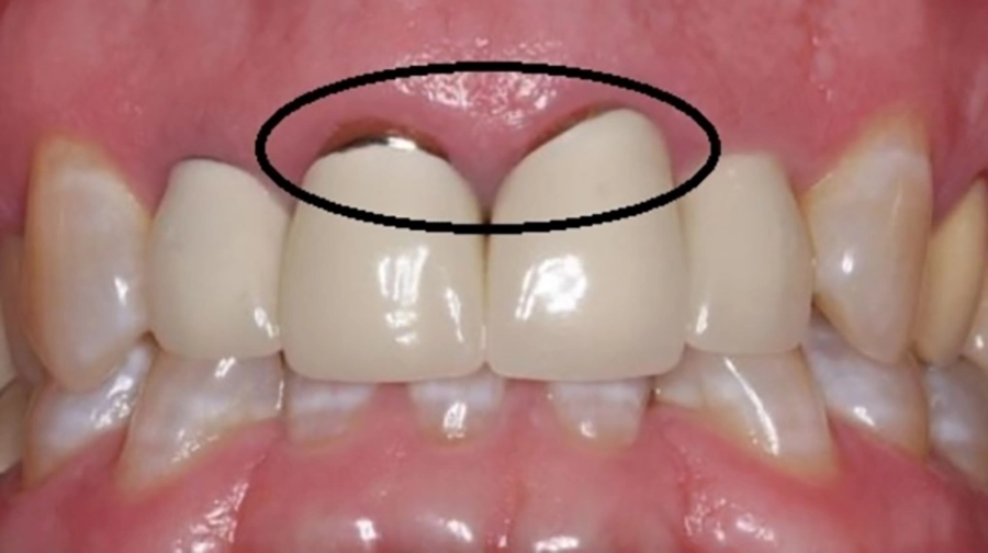 Phục Hình Răng Sứ Toàn Sứ Khác Gì Răng Sứ Kim Loại?