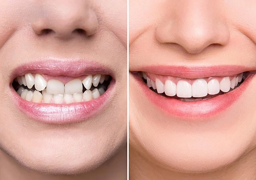 Phục Hình Răng Sứ Toàn Sứ Khác Gì Răng Sứ Kim Loại?