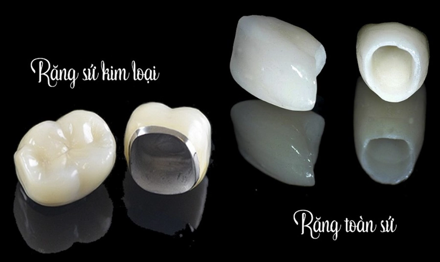 Phục Hình Răng Sứ Toàn Sứ Khác Gì Răng Sứ Kim Loại?