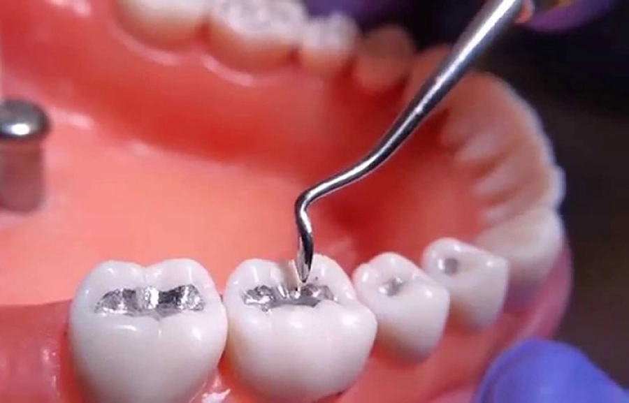 Răng Ê Buốt Khi Ăn Nóng Lạnh: Nguyên Nhân & Cách Khắc Phục