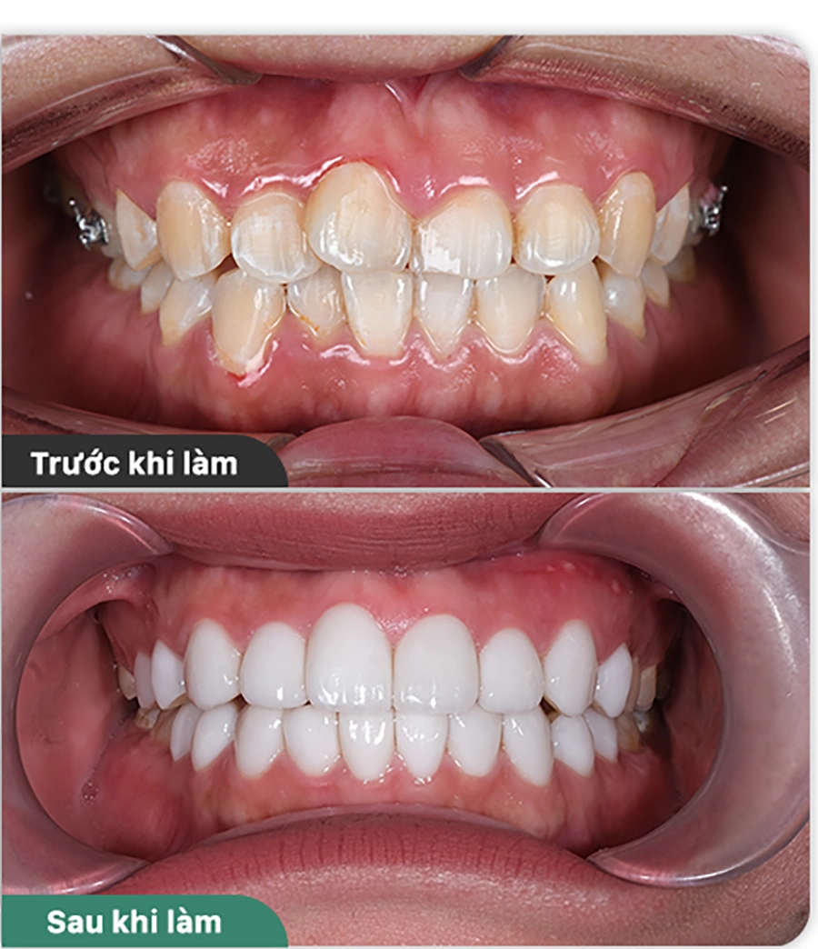 Răng Khấp Khểnh Nhẹ – Nên Niềng Hay Bọc Sứ?