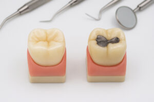 Trám Răng Thẩm Mỹ Composite Khác Gì Amalgam?