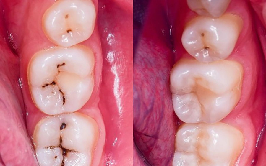 Trám Răng Thẩm Mỹ Composite Khác Gì Amalgam?