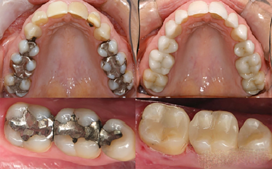Trám Răng Thẩm Mỹ Composite Khác Gì Amalgam?