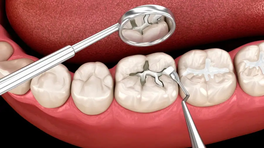 Trám Răng Thẩm Mỹ Composite Khác Gì Amalgam?