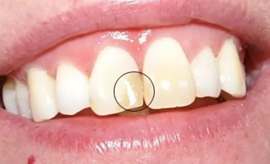 Trám Răng Thẩm Mỹ Composite Khác Gì Amalgam?