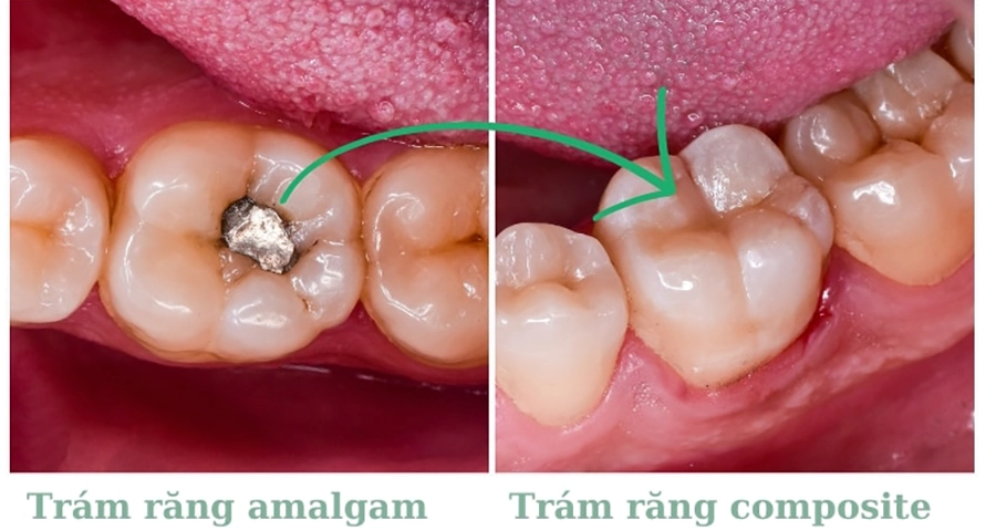 Trám Răng Thẩm Mỹ Composite Khác Gì Amalgam?