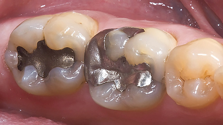 Trám Răng Thẩm Mỹ Composite Khác Gì Amalgam?